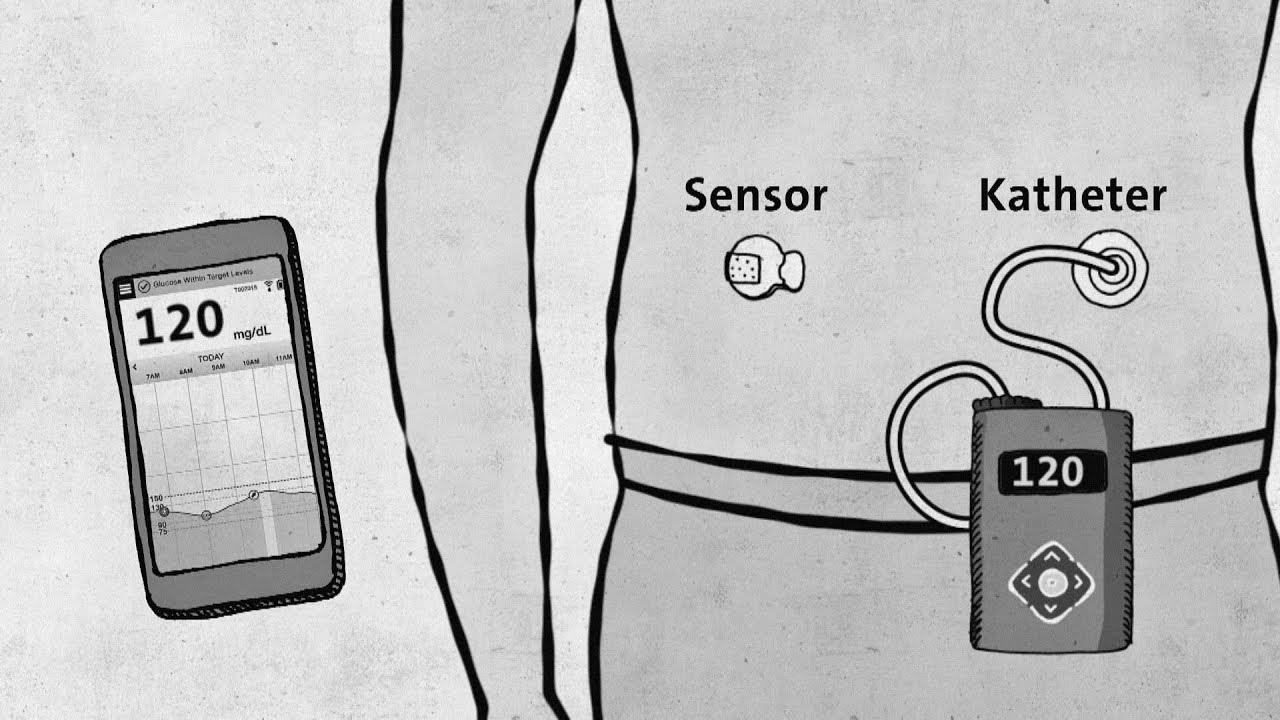 Sort 1 diabetes – fashionable technology without approval – good to know